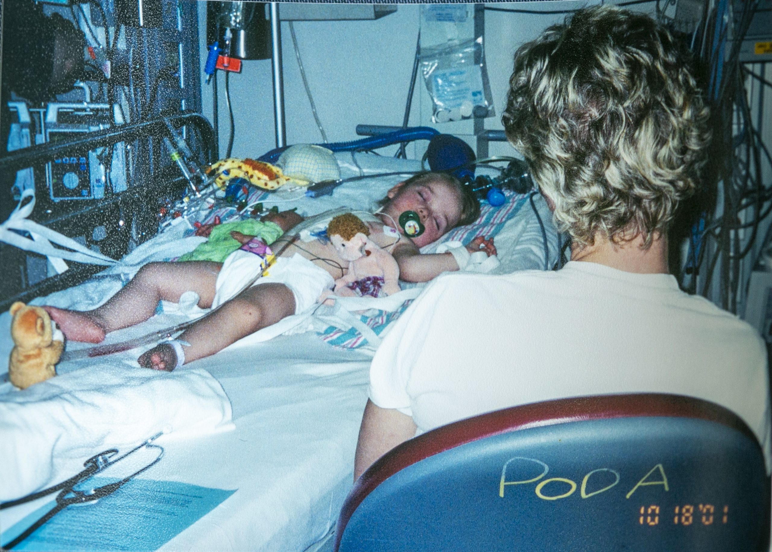 Duke heart patient Josie Donnigan as a baby during her heart surgery at the University of Michigan Medical Center in 2001, where Piers Barker, MD, then a pediatric cardiology fellow, treated her. Years later, both moved to NC, and Dr. Barker now treats Josie at Duke. Barker used a 3D printed model of Donnigan's heart to aid in her recent surgery. 